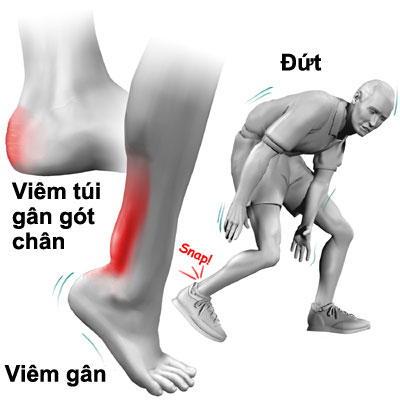 dinhduonghoc.com - Viêm gân là gì?