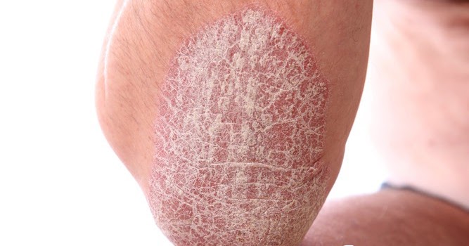 dinhduonghoc.com - Một số điều cần biết về bệnh vảy nến