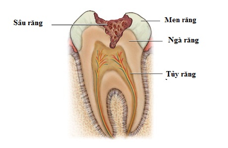 dinhduonghoc.com - Bệnh sâu răng là gì?