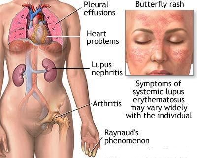 dinhduonghoc.com - Bệnh Lupus là gì?