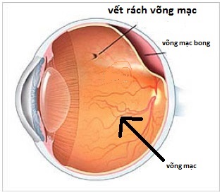 dinhduonghoc.com - Bong võng mạc, bệnh cấp cứu về mắt