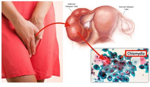 dinhduonghoc.com - Bệnh Chlamydia là gì? Cách phòng chống và điều trị