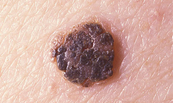 dinhduonghoc.com - Tiết bã sừng (Keratoses) là gì?