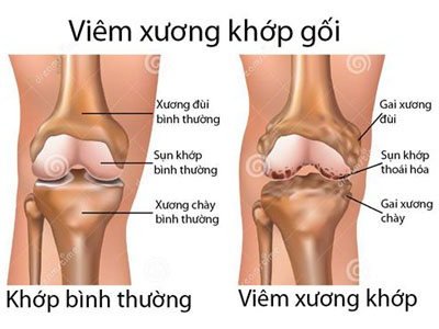 dinhduonghoc.com - Viêm khớp là gì?