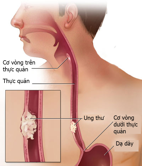 dinhduonghoc.com - Ung thư thực quản là gì?