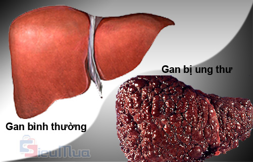 dinhduonghoc.com - Ung thư gan là gì? Cách phòng tránh và điều trị