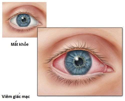 dinhduonghoc.com - Viêm giác mạc, bệnh gây sưng, đỏ, đau, chảy rử mắt và nhạy cảm ánh sáng
