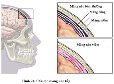 dinhduonghoc.com - Bệnh viêm màng não