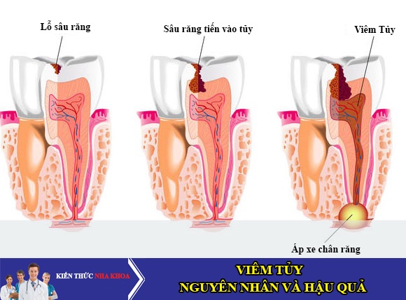 dinhduonghoc.com - Bệnh tủy răng?