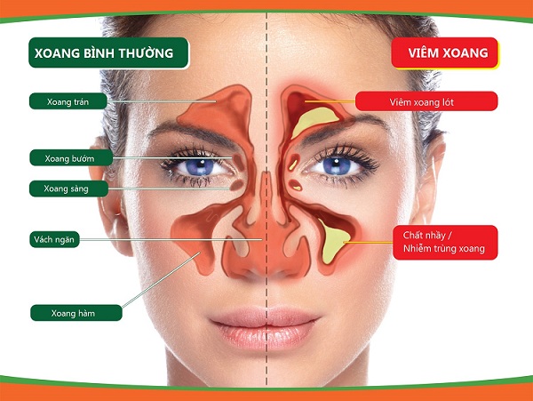 dinhduonghoc.com - Tìm hiểu về bệnh viêm xoang
