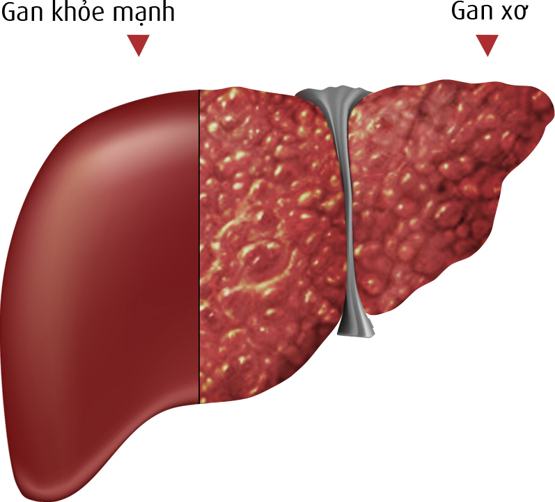 dinhduonghoc.com - Xơ gan là gì? Cách điều trị xơ gan bằng thuốc nam?