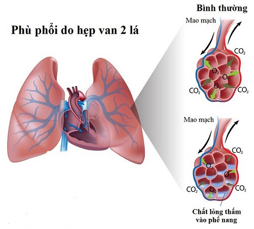 dinhduonghoc.com - Bệnh phù phổi gây khó thở và có thể tử vong