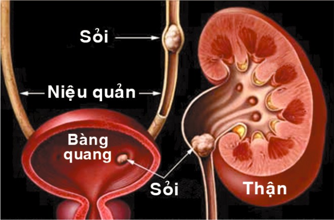dinhduonghoc.com - Sỏi tiết niệu là gì?