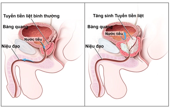 dinhduonghoc.com - Viêm tuyến tiền liệt là gì?