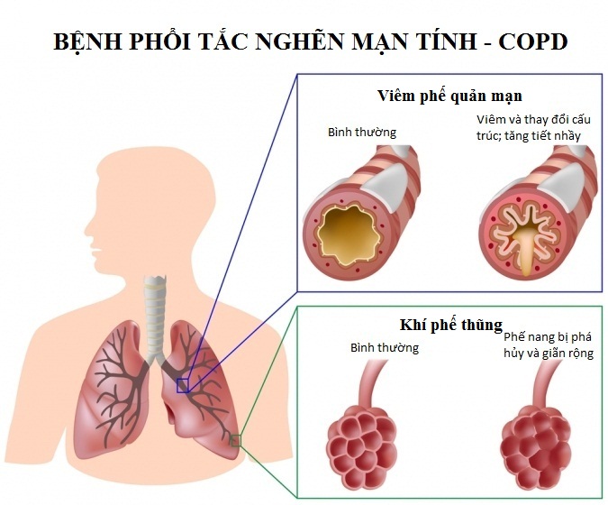 dinhduonghoc.com - Nghẽn tắc phổi mạn tính là bệnh gì?