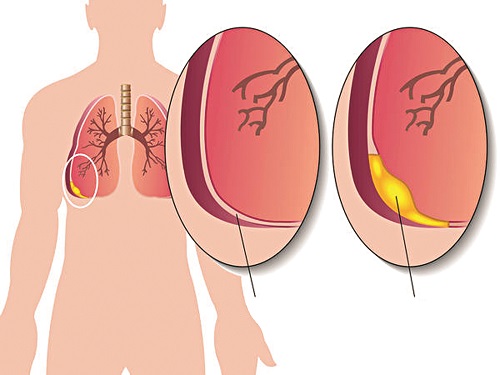 dinhduonghoc.com - Tìm hiểu về bệnh viêm màng phổi