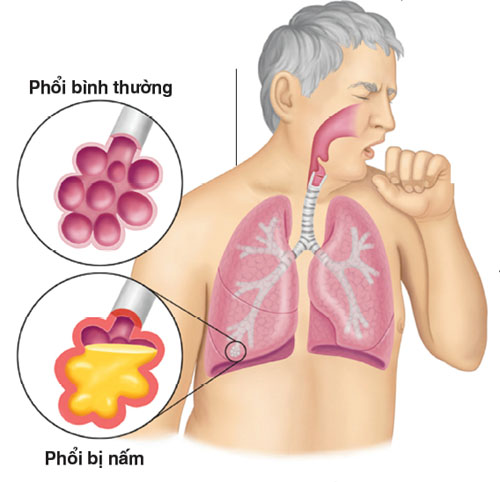 dinhduonghoc.com - Bệnh lao và những điều cần biết