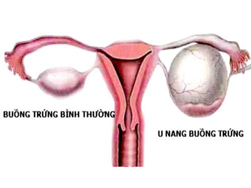 dinhduonghoc.com - Tìm hiểu về u nang buồng trứng