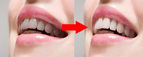 dinhduonghoc.com - cách làm trắng răng hiệu quả nhất tại nhà