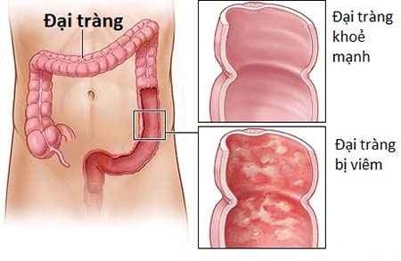 dinhduonghoc.com - các bài thuốc chữa viêm đại tràng cấp và mãn tính