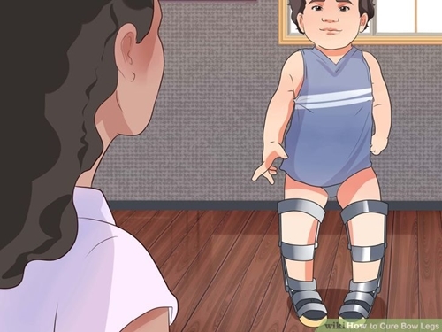 dinhduonghoc.com - cách khắc phục chân vòng kiềng ở trẻ